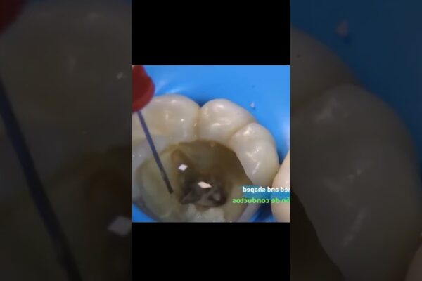 Tratament de canal pentru dinte Tratament de canal pentru dinte #short